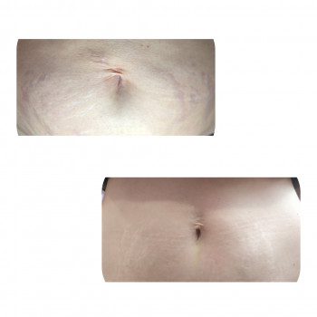 Мезотерапия :проработка живота на упругость и уменьшение по