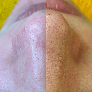 Результат комбинированной чистки