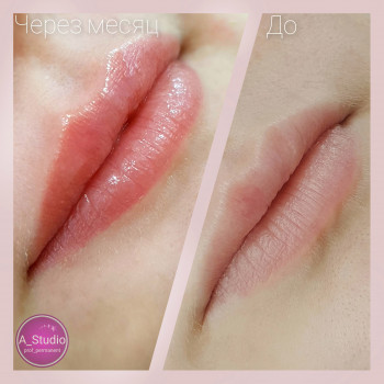 До и Через месяц после процедуры, натуральный еффект
