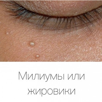 Удаляю миллиумы