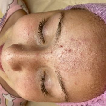 Подростковые чистки