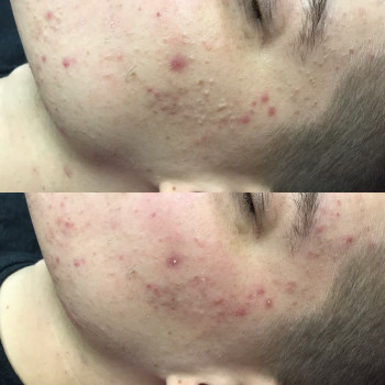 Чистка лица, фото - косметолог-эстетист Анна Боярских