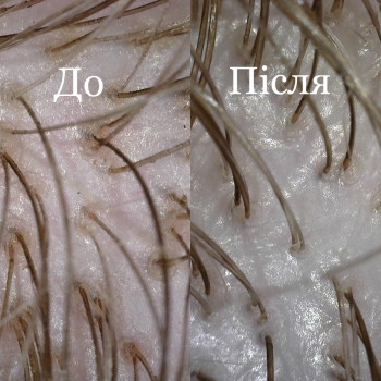 Шкіра після процедури вирівнювання рН