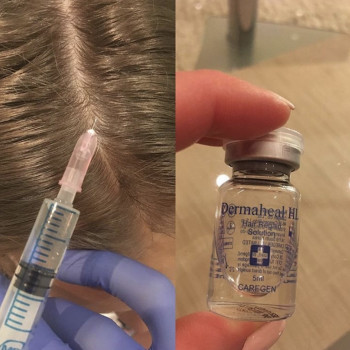 Мезотерапия кожи головы