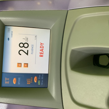 Лазерная эпиляция