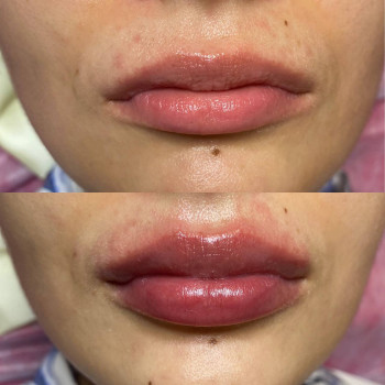 Збільшення губ
                    Салон красоты Шалена Краса Полтава