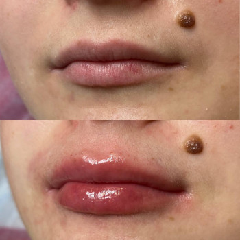 Збільшення губ
                    Салон красоты Шалена Краса Полтава