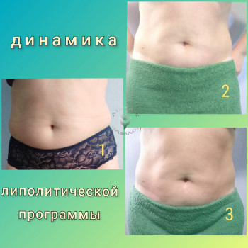 УЗ ліполіз
                    Масажист Юлія Київ