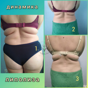 УЗ ліполіз
                    Масажист Юлія Київ