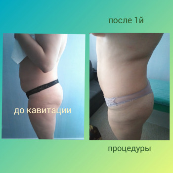 Результат 4х процедур