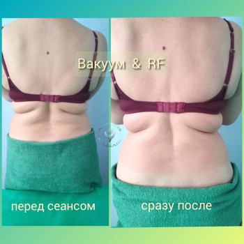 Вакуум + RF лифтинг
                    Масажист Юлія Київ