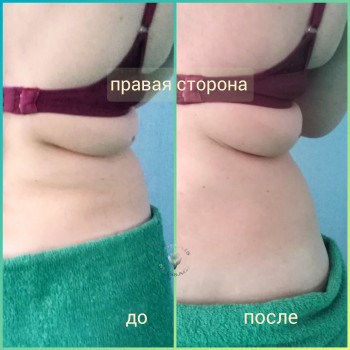 Вакуум + RF лифтинг
                    Масажист Юлія Київ