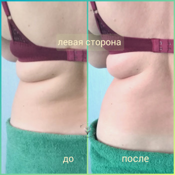 Вакуум + RF лифтинг
                    Масажист Юлія Київ