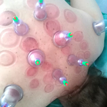 Баночный массаж
                    Массажист Юлія Киев