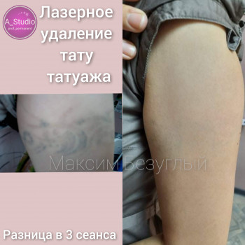 Лазерное удаление тату/татуажа
                    Мастер перманентного макияжа Анна Черкассы
