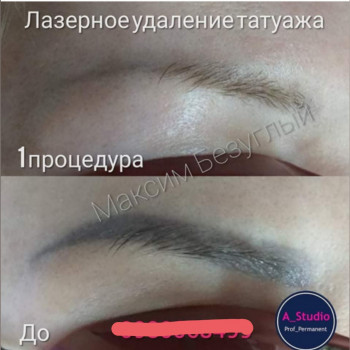 Лазерное удаление тату/татуажа
                    Мастер перманентного макияжа Анна Черкассы