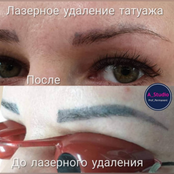 Лазерное удаление тату/татуажа
                    Мастер перманентного макияжа Анна Черкассы
