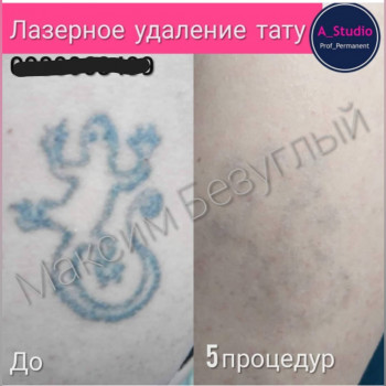 Лазерное удаление тату/татуажа
                    Мастер перманентного макияжа Анна Черкассы