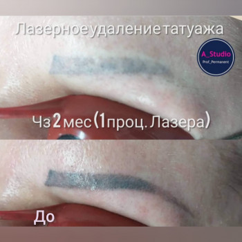 Лазерное удаление тату/татуажа
                    Мастер перманентного макияжа Анна Черкассы