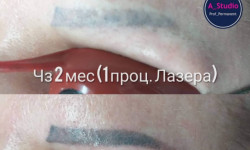 Лазерное удаление тату/татуажа Мастер перманентного макияжа Анна Черкассы