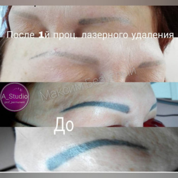 Лазерное удаление тату/татуажа
                    Мастер перманентного макияжа Анна Черкассы