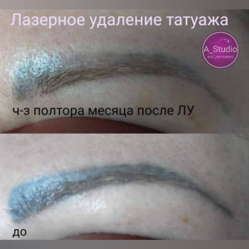 Лазерное удаление тату/татуажа
                    Мастер перманентного макияжа Анна Черкассы