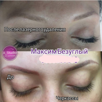 Лазерное удаление тату/татуажа
                    Мастер перманентного макияжа Анна Черкассы
