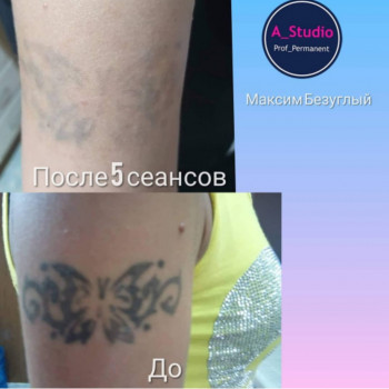 Лазерное удаление тату/татуажа
                    Мастер перманентного макияжа Анна Черкассы