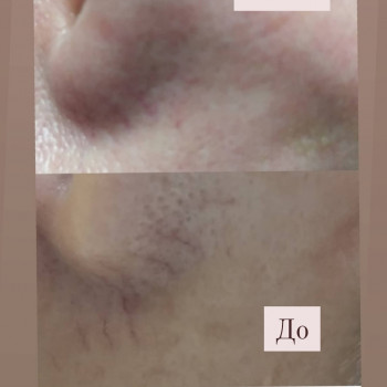 Неинвазивная мезотерапия устраняет ещё и такие эстетические 