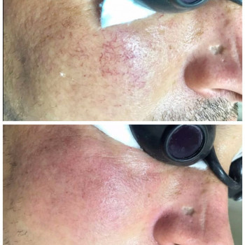 Видалення судин. Неперевершений результат уже після першої п