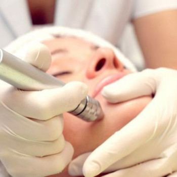 Мікродермобразія обличчя (алмазний пілінг)