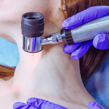 Дерматоскопія. Не забувайте перевіряти свої родимки.