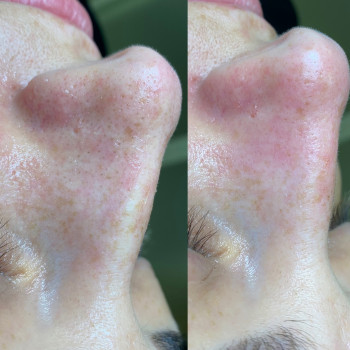 Чистка лица механическая