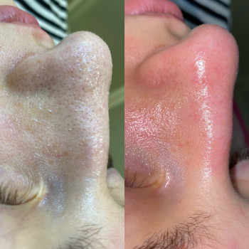 Чистка лица механическая