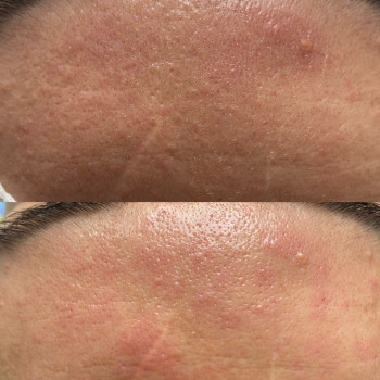 Чистка лица механическая