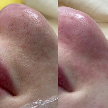 Чистка лица механическая