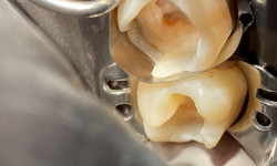 Лікування карієсу від 300 гривень Стоматолог Василь Ужгород