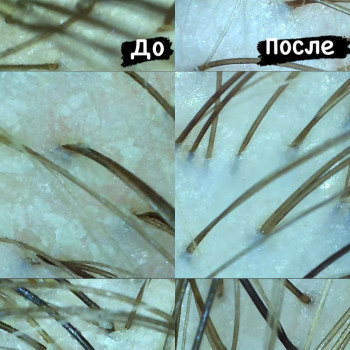Результат эксфолиации (пилинга) кожи головы