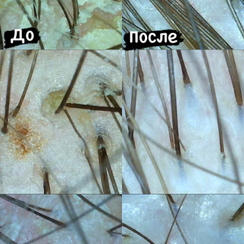 Результат эксфолиации (пилинга) кожи головы