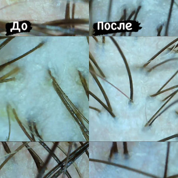 Результат эксфолиации (пилинга) кожи головы