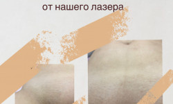 Лазерная эпиляция глубокого бикини Массажист Анна Киев