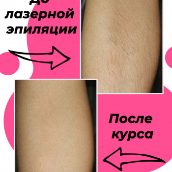 Лазерна епіляція стегон
                    Салон красоты Мастерская Красоты "Юлии Юдиной" Киев