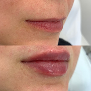 Збільшення губ