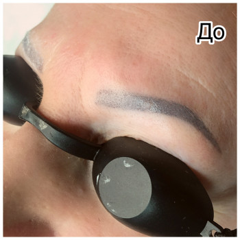 Удаление старого татуажа лазером