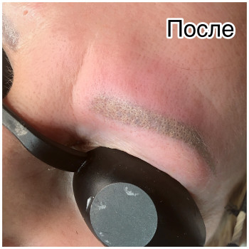 Удаление старого татуажа лазером