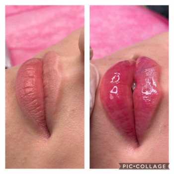 Контурная пластика