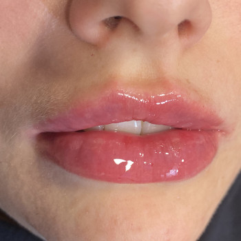 Контурная пластика