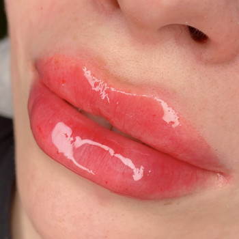 Контурная пластика