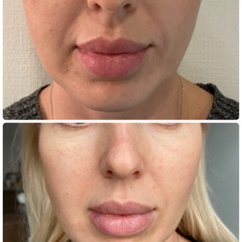 Контурна пластика обличчя