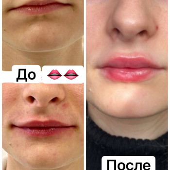 Контурна пластика губ